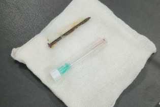 Tanpa Bedah! RSUD Arifin Achmad Tangani Kasus Langka Paku 5 Cm Masuk ke Saluran Napas