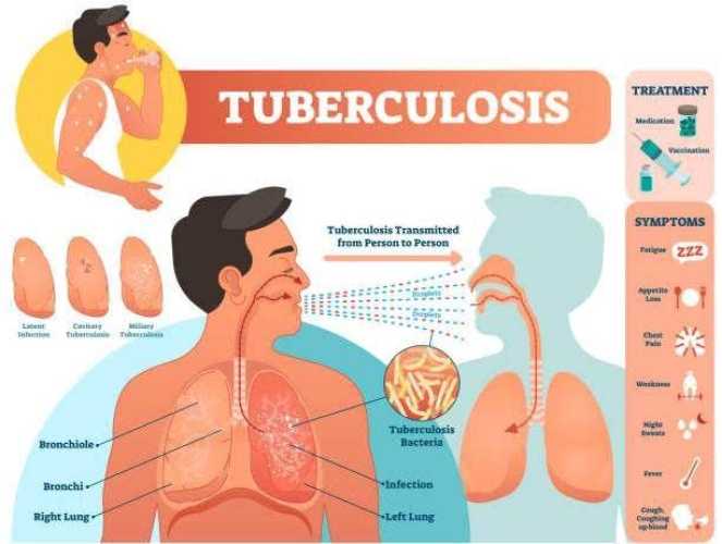 Dinkes Inhil Himbau Masyarakat Tentang Pentingnya Penanganan TB yang Efektif